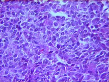 poorly differentiated synovial sarcoma