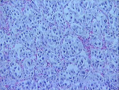 carotid body paraganglioma