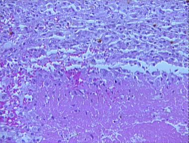 epitheliod sarcoma