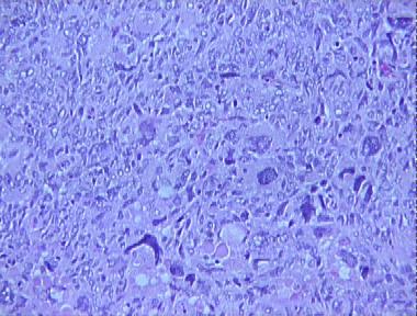 clear cell sarcoma