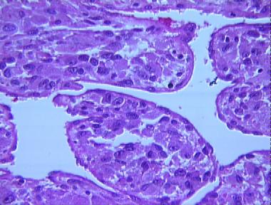 alveolar soft part sarcoma