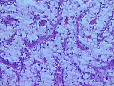 metastatic renal cell carcinoma