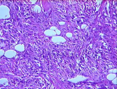 diffuse mesothelioma