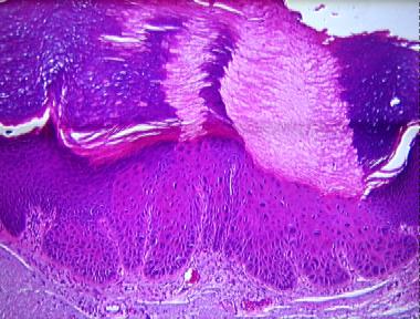 actinic keratosis, bowenoid type