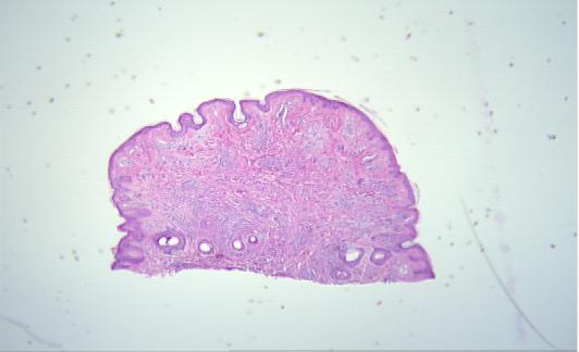 dysplastic nevus (stepsections)