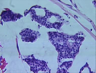 mucinous eccrine carcinoma
