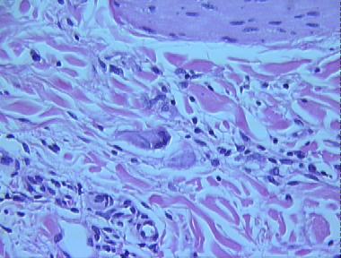 actinic granuloma