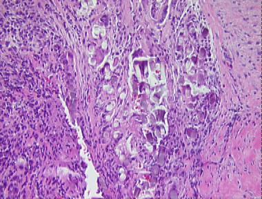 suture granuloma