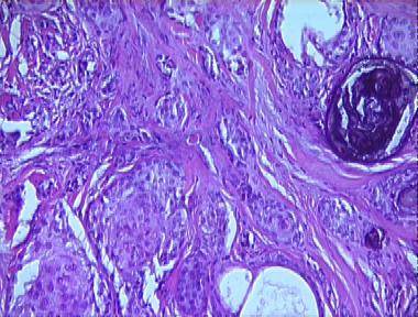 microcystic adnexal carcinoma