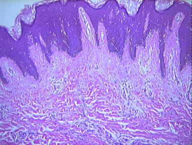 dermatofibroma, surface of