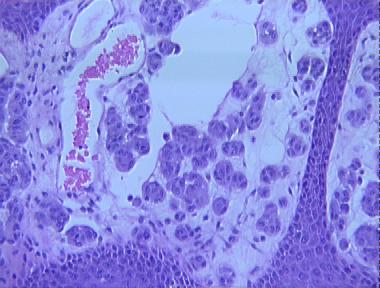 Spitz nevus, childhood variant