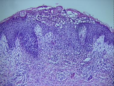 erythema toxicum neonatorum