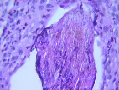 dermatophytic folliculitis