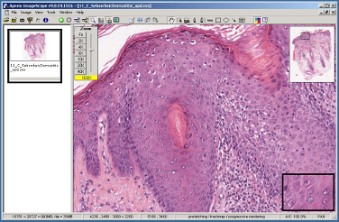 Virtual Dermatopathology Image 2